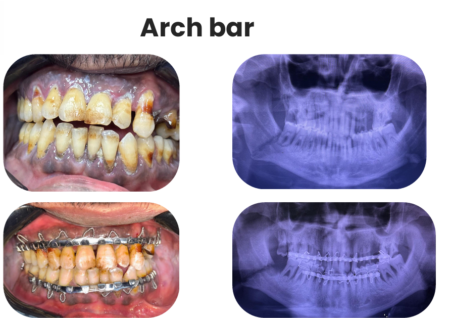 Arch bar
